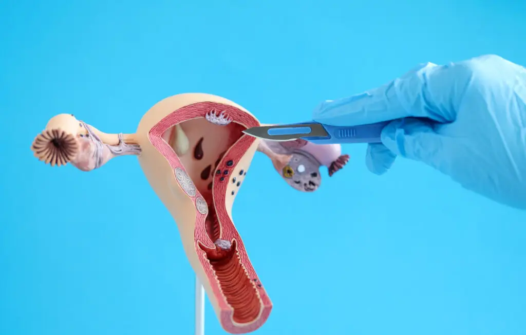 הסרת פוליפ ברחם