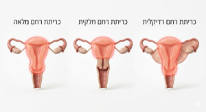 סוגי כריתת רחם - מה ההבדל בין מלאה, חלקית ורדיקלית?
